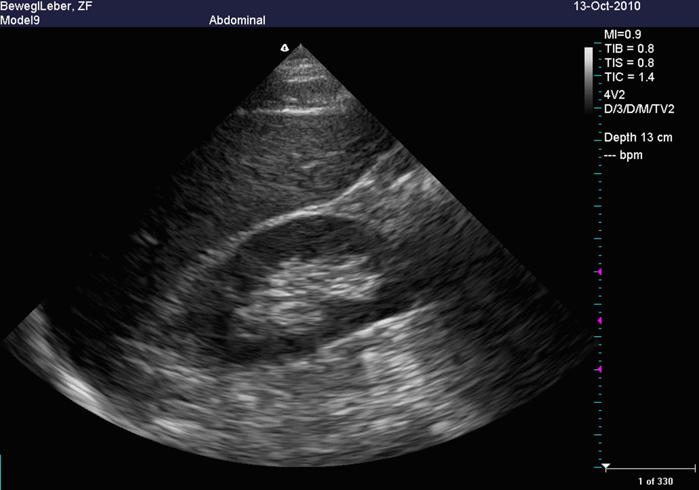 Sonographie der Niere Sonographie der Niere